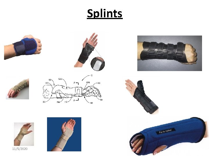 Splints 11/5/2020 29 