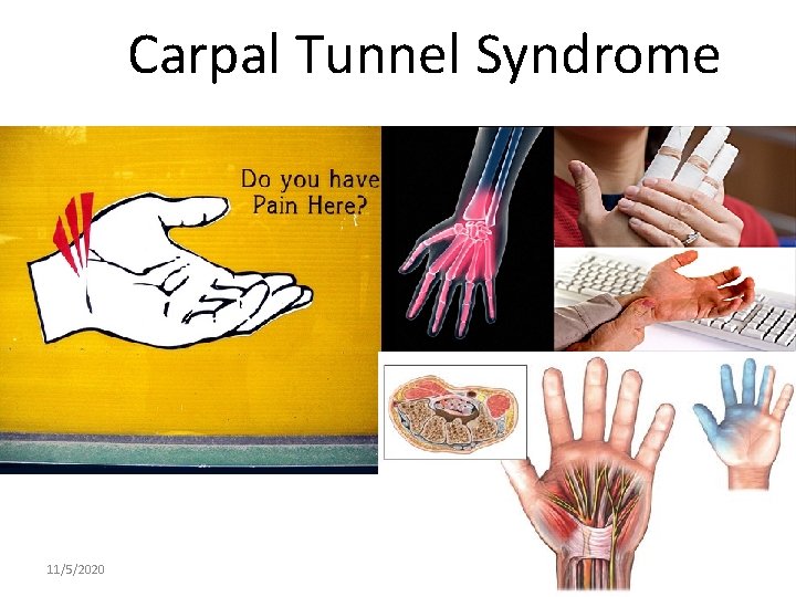 Carpal Tunnel Syndrome 11/5/2020 3 