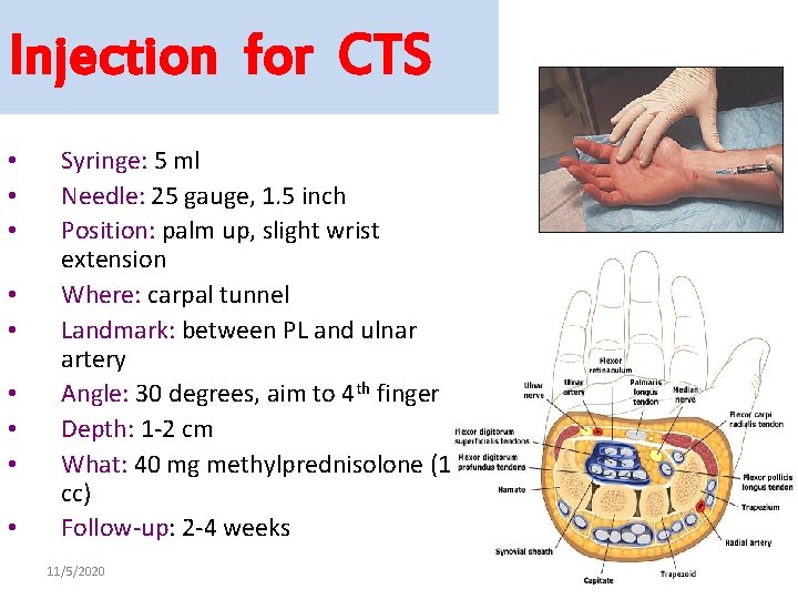 Injection for CTS • • • Syringe: 5 ml Needle: 25 gauge, 1. 5