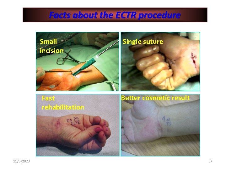 Facts about the ECTR procedure 11/5/2020 Small incision Single suture Fast rehabilitation Better cosmetic