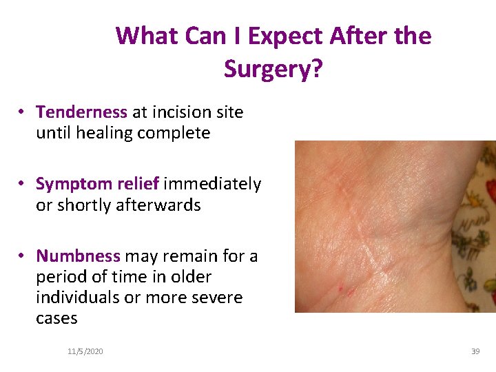 What Can I Expect After the Surgery? • Tenderness at incision site until healing