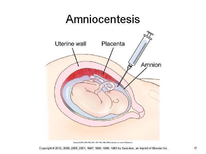 Amniocentesis Copyright © 2012, 2009, 2005, 2001, 1997, 1993, 1988, 1983 by Saunders, an