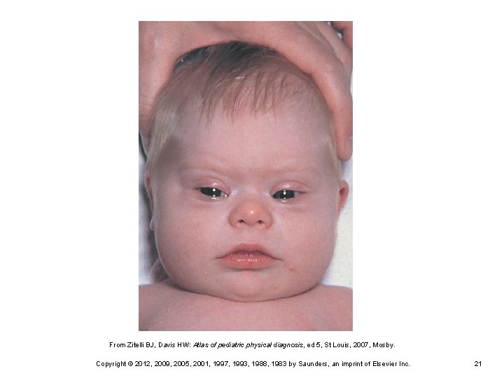 From Zitelli BJ, Davis HW: Atlas of pediatric physical diagnosis, ed 5, St Louis,
