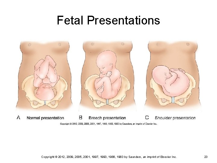 Fetal Presentations Copyright © 2012, 2009, 2005, 2001, 1997, 1993, 1988, 1983 by Saunders,