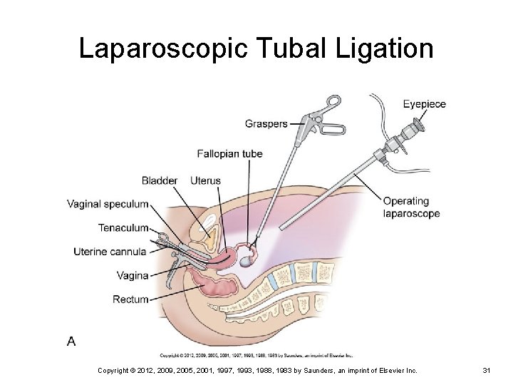 Laparoscopic Tubal Ligation Copyright © 2012, 2009, 2005, 2001, 1997, 1993, 1988, 1983 by