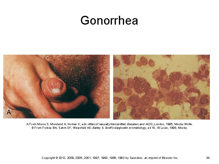 Gonorrhea A From Morse S, Moreland A, Homes K, eds: Atlas of sexually transmitted