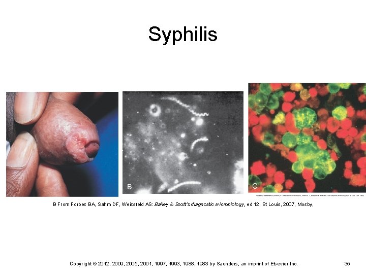 Syphilis B From Forbes BA, Sahm DF, Weissfeld AS: Bailey & Scott’s diagnostic microbiology,