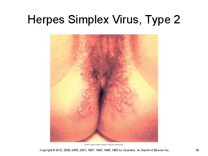 Herpes Simplex Virus, Type 2 Copyright © 2012, 2009, 2005, 2001, 1997, 1993, 1988,