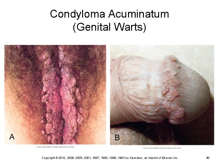 Condyloma Acuminatum (Genital Warts) Copyright © 2012, 2009, 2005, 2001, 1997, 1993, 1988, 1983