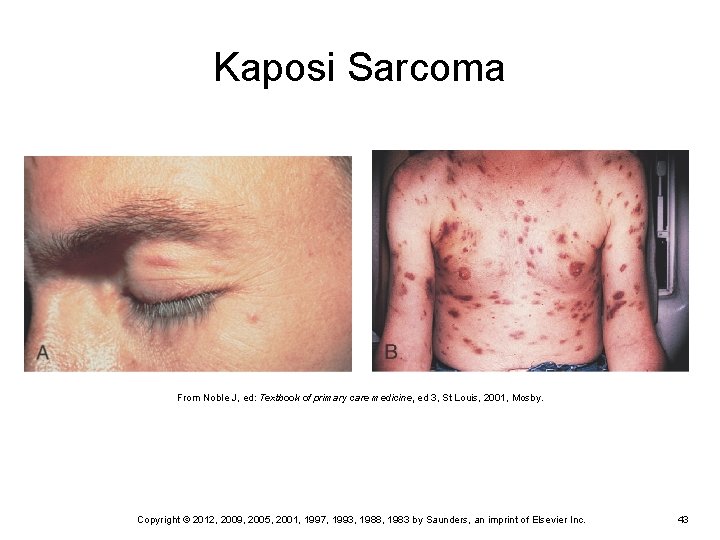 Kaposi Sarcoma From Noble J, ed: Textbook of primary care medicine, ed 3, St