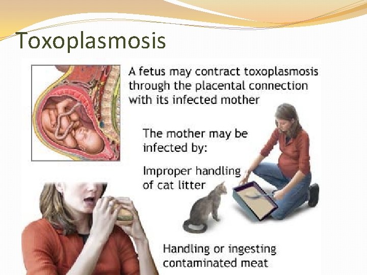 Toxoplasmosis 