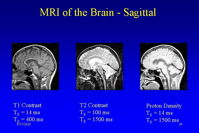 MRI of the Brain - Sagittal T 1 Contrast TE = 14 ms TR