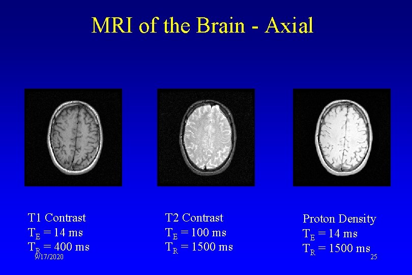 MRI of the Brain - Axial T 1 Contrast TE = 14 ms TR