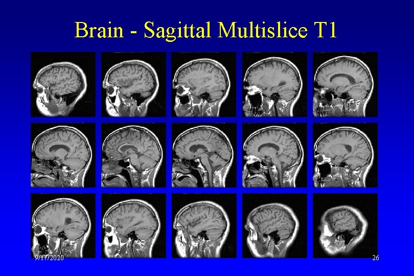 Brain - Sagittal Multislice T 1 9/17/2020 26 