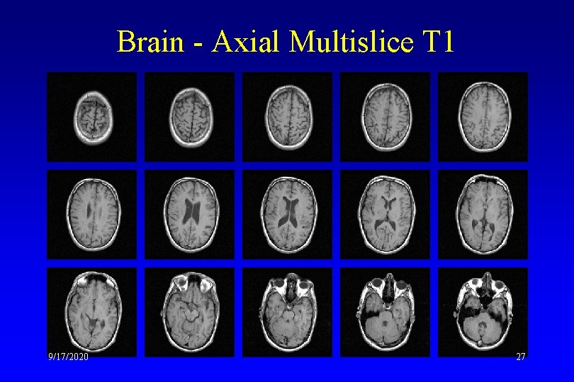 Brain - Axial Multislice T 1 9/17/2020 27 