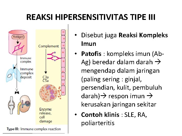 REAKSI HIPERSENSITIVITAS TIPE III • Disebut juga Reaksi Kompleks Imun • Patofis : kompleks