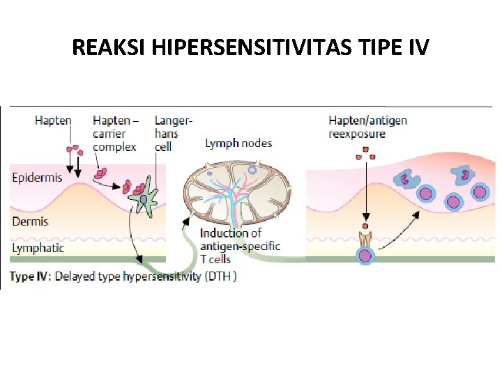 REAKSI HIPERSENSITIVITAS TIPE IV 