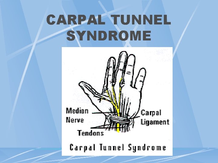 CARPAL TUNNEL SYNDROME CARPAL TUNNEL SYNDROME