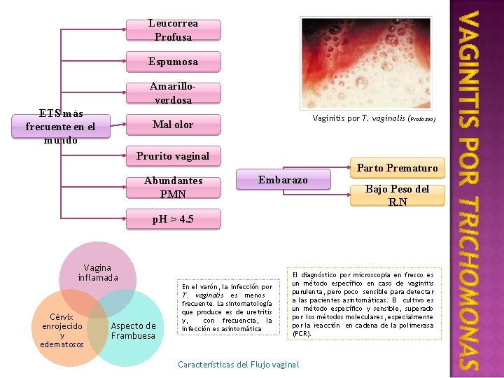 Leucorrea Profusa Espumosa Amarilloverdosa ETS más frecuente en el mundo Vaginitis por T. vaginalis