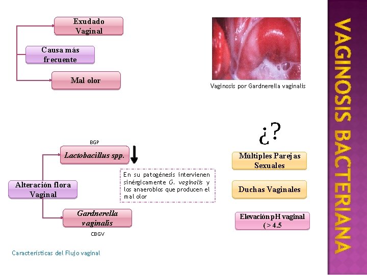 Exudado Vaginal Causa más frecuente Mal olor Vaginosis por Gardnerella vaginalis BGP Lactobacillus spp.