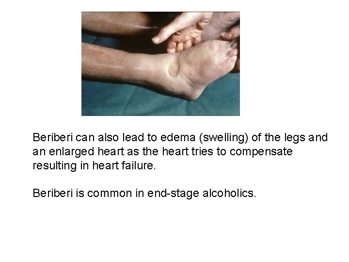 Beriberi can also lead to edema (swelling) of the legs and an enlarged heart Beriberi can also lead to edema (swelling) of the legs and an enlarged heart