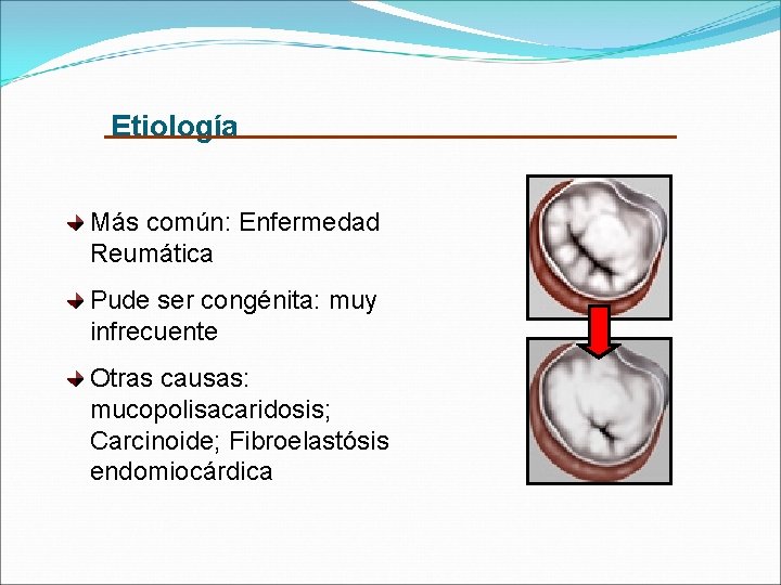 Etiología Más común: Enfermedad Reumática Pude ser congénita: muy infrecuente Otras causas: mucopolisacaridosis; Carcinoide;