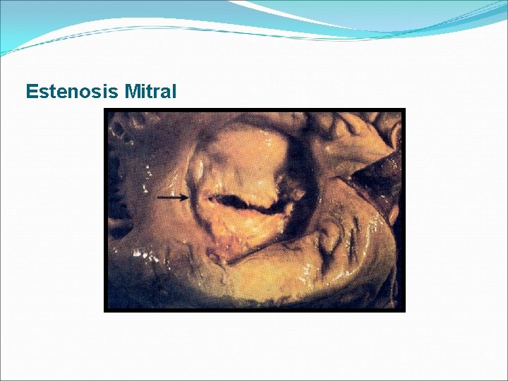 Estenosis Mitral 