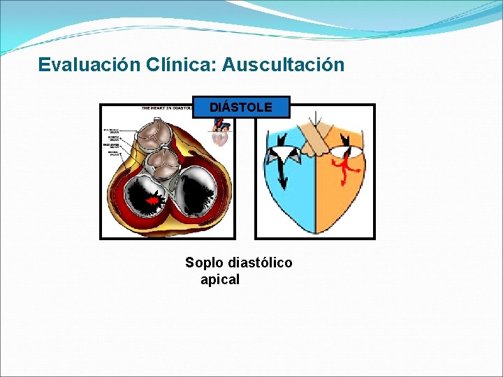 Evaluación Clínica: Auscultación DIÁSTOLE Soplo diastólico apical 