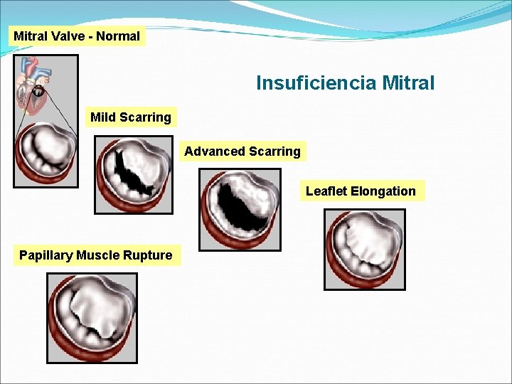 Mitral Valve - Normal Insuficiencia Mitral Mild Scarring Advanced Scarring Leaflet Elongation Papillary Muscle