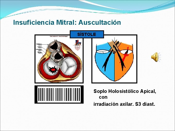 Insuficiencia Mitral: Auscultación SÍSTOLE Soplo Holosistólico Apical, con irradiación axilar. S 3 diast. 