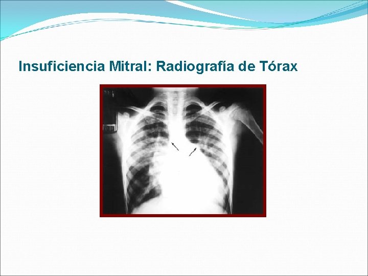 Insuficiencia Mitral: Radiografía de Tórax 
