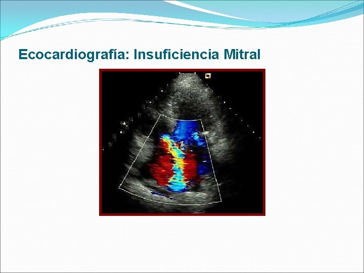 Ecocardiografía: Insuficiencia Mitral 