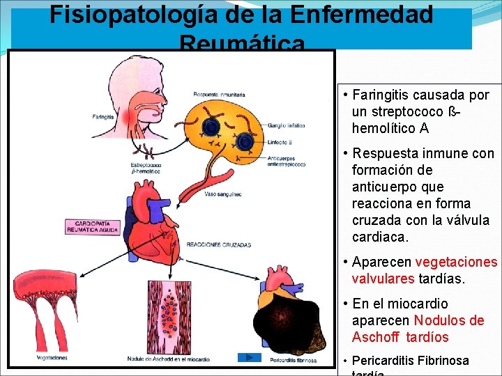Fisiopatología de la Enfermedad Reumática • Faringitis causada por un streptococo ßhemolítico A •