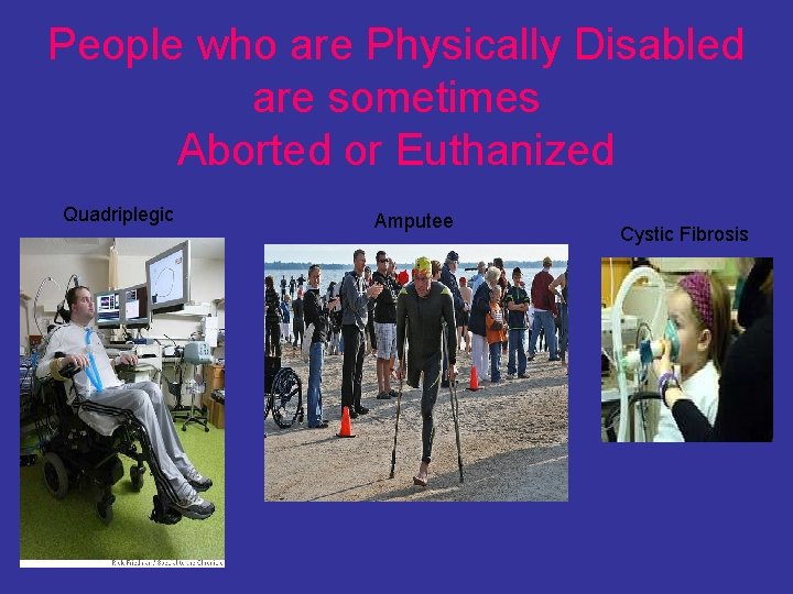 People who are Physically Disabled are sometimes Aborted or Euthanized Quadriplegic Amputee Cystic Fibrosis