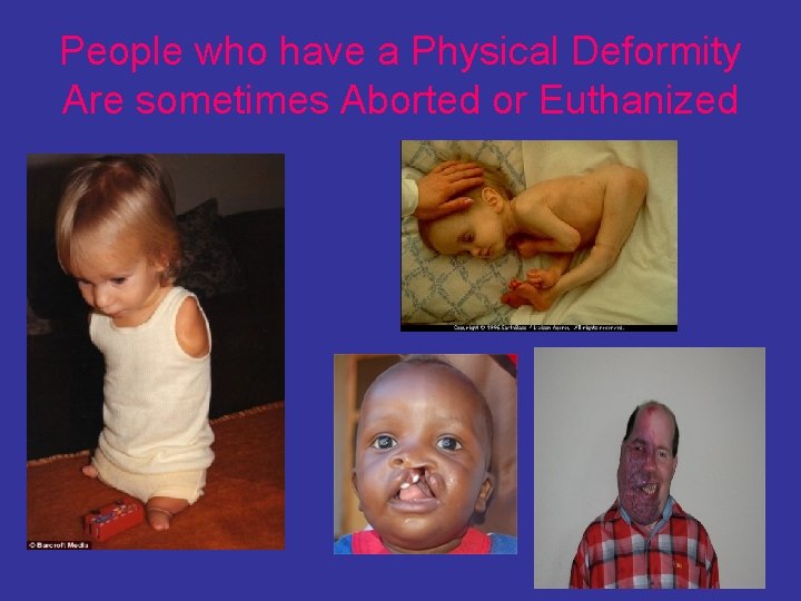 People who have a Physical Deformity Are sometimes Aborted or Euthanized 