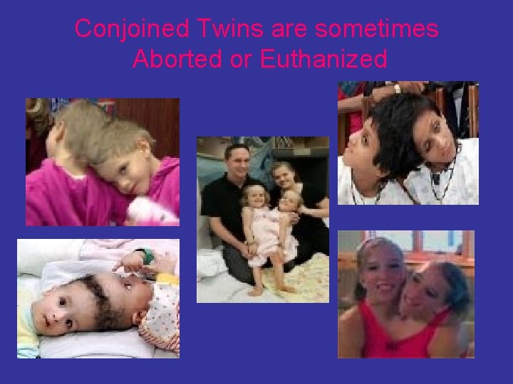 Conjoined Twins are sometimes Aborted or Euthanized 