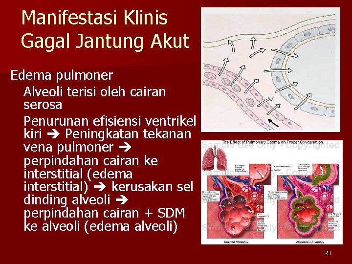 Manifestasi Klinis Gagal Jantung Akut Edema pulmoner Alveoli terisi oleh cairan serosa Penurunan efisiensi