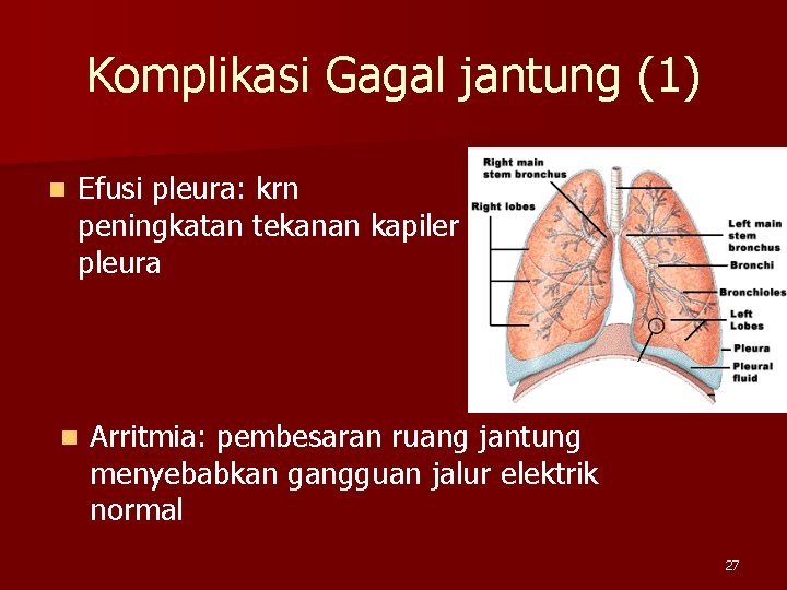 Komplikasi Gagal jantung (1) n Efusi pleura: krn peningkatan tekanan kapiler pleura n Arritmia: