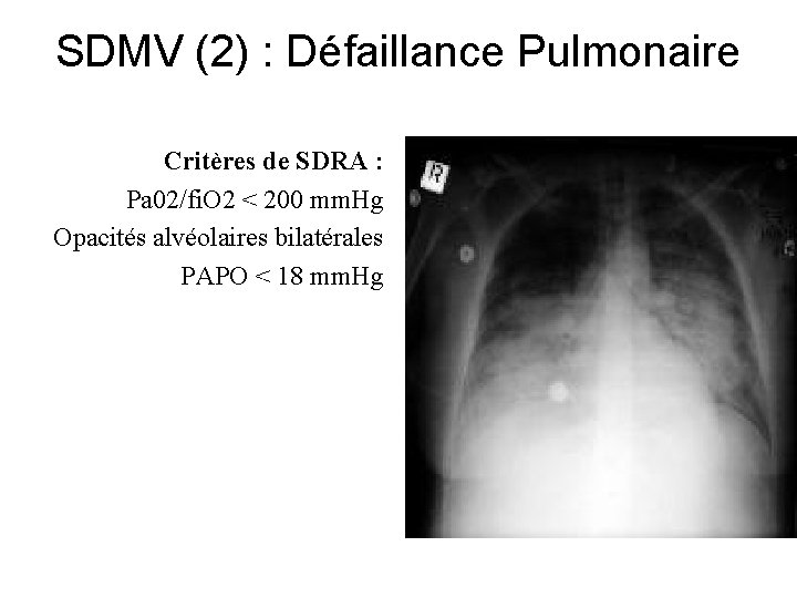 SDMV (2) : Défaillance Pulmonaire Critères de SDRA : Pa 02/fi. O 2 <