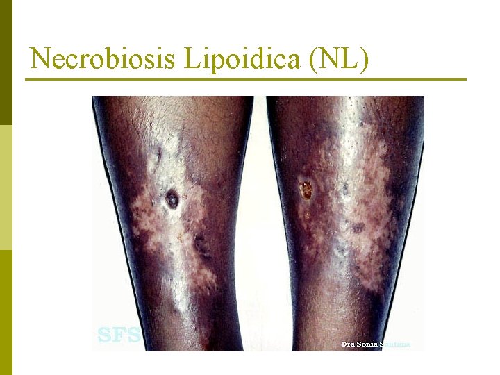 Necrobiosis Lipoidica (NL) 