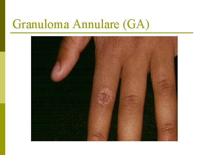 Granuloma Annulare (GA) 