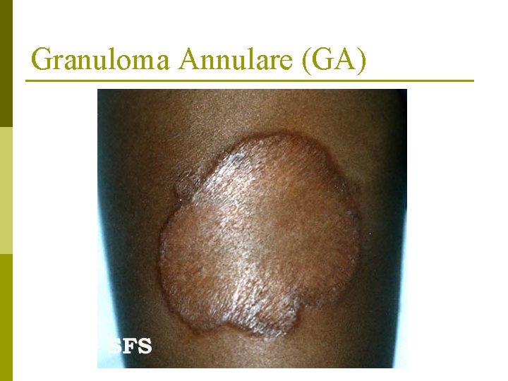 Granuloma Annulare (GA) 