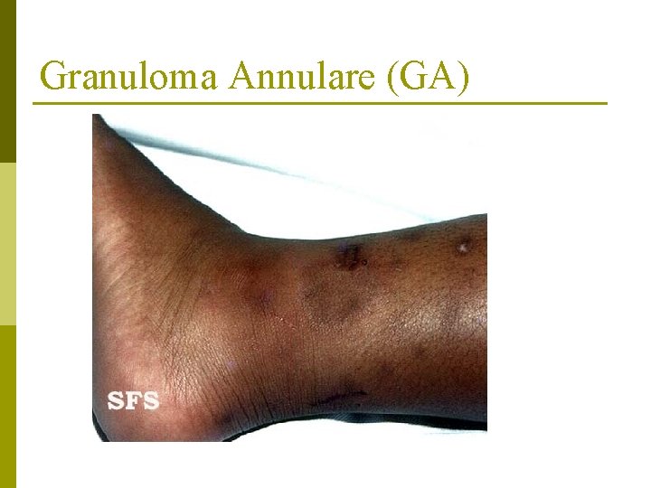 Granuloma Annulare (GA) 