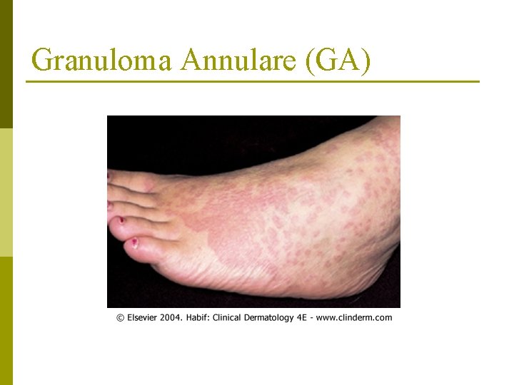 Granuloma Annulare (GA) 