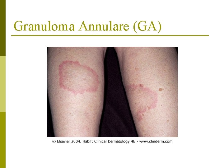 Granuloma Annulare (GA) 