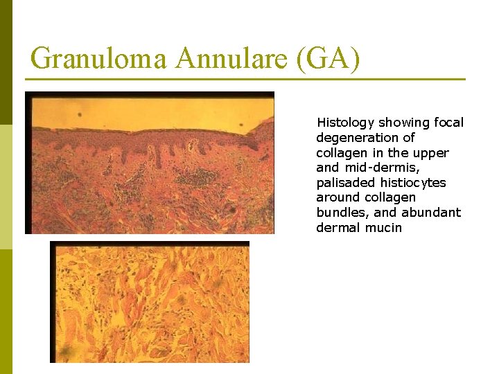 Granuloma Annulare (GA) Histology showing focal degeneration of collagen in the upper and mid-dermis,