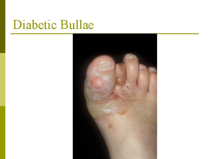 Diabetic Bullae 