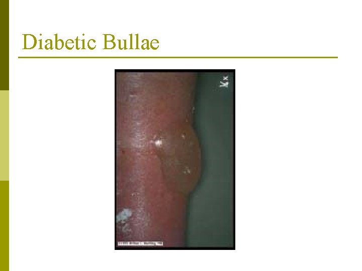 Diabetic Bullae 