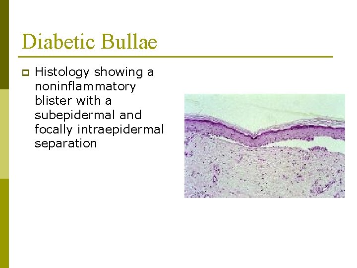 Diabetic Bullae p Histology showing a noninflammatory blister with a subepidermal and focally intraepidermal