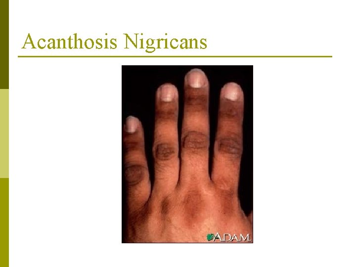 Acanthosis Nigricans 